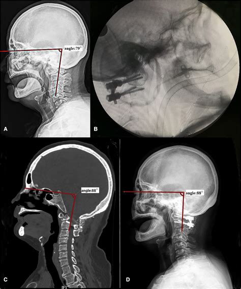 A case of a 69-year-old female patient with Os odontoideum. Before ...