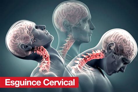 Esguince Cervical Fisio Care