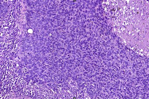 Superficial Basal Cell Carcinoma Histology