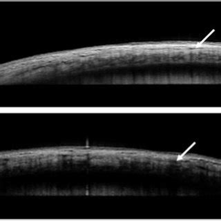 Edema space detected between the layers of the sclera (white arrows) in... | Download Scientific ...