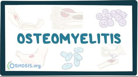 Osteomyelitis Causes Symptoms Diagnosis Treatment Pathology