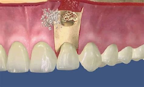 Apikal Rezeksiyon Nedir Konya Di I Dentium Sel Uklu