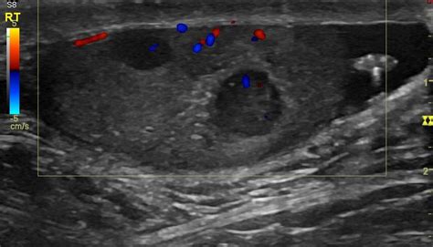 Testicular Seminoma Image Radiopaedia Org