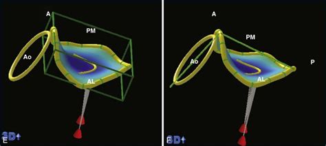 Normal Mitral Valve Anatomy and Measurements | Radiology Key