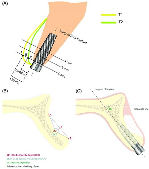 A Labial Bone Width Measurement The Yellow Line Represents Bony