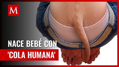 Increíble Nace bebé con cola humana en Guyana YouTube