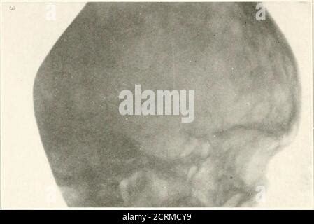 Roentgen Diagnosis Of Diseases Of The Head Fig 13