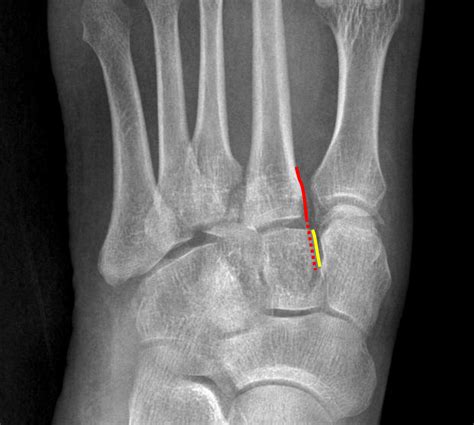 Lisfranc Fracture Mri