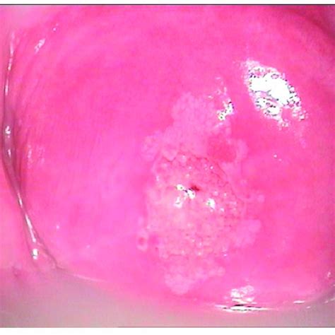 Colposcopic mage of a low-grade LSIL PAP smear. At the border of the ...