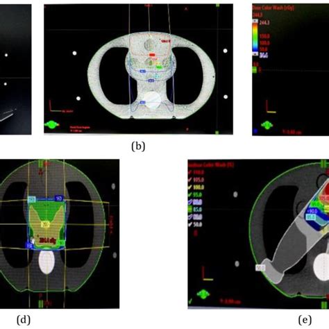 A Ct Image Of Cirs Phantom Treatment Planning For B Case 1 C Download Scientific Diagram