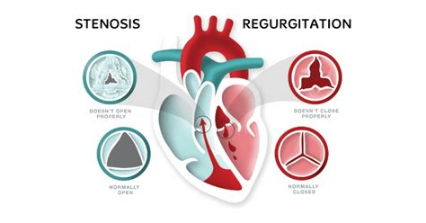 Heart Valve Disease And Its Causes Cardiologist