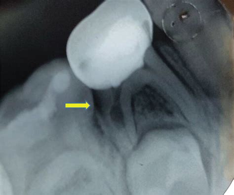 Internal root resorption in the tooth treated with TheraCal after 6 ...