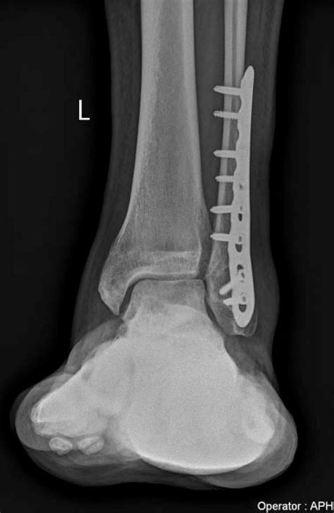 Spiral Fracture Distal Fibula Hot Sex Picture