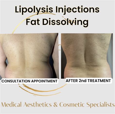 Fat Dissolving Injections Lipolysis Fat Dissolving Lipolysis Macsoflondon Medical