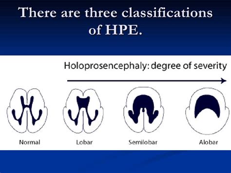 Holoprosencephaly