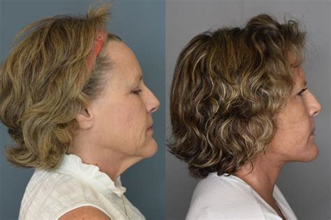 Facelift Beverly Hills Plastic Surgeon Natural Facelift