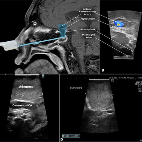 Side Firing Intraoperative Ultrasound In Endoscopic Endonasal Pituitary