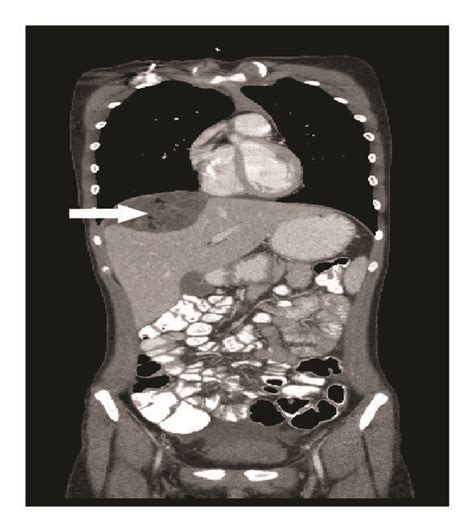 Computed Tomography Abdomen And Pelvis Follow Up Imaging At 8 Months