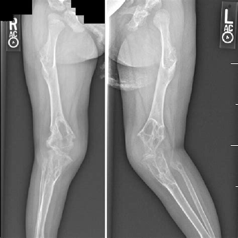 Lower extremity radiographs demonstrating acetabular dysplasia, coxa ...