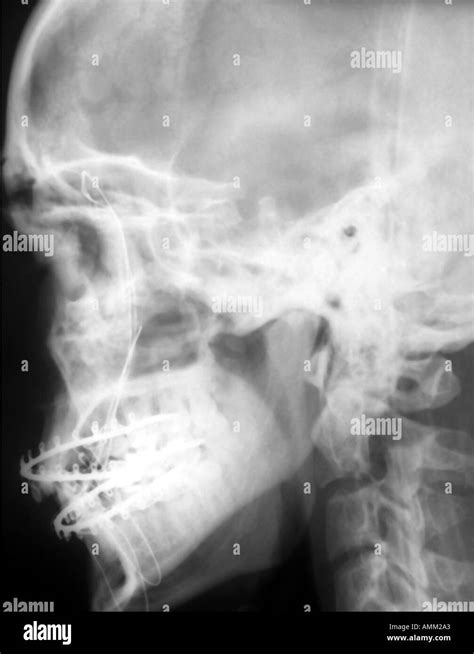 Mandibular Fracture X Ray