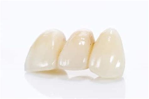 Resin Bonded Bridges | Buffalo Family Dentist