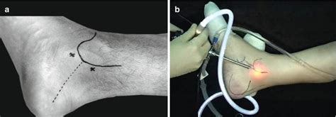 Posterior Tibial Tendoscopy Musculoskeletal Key