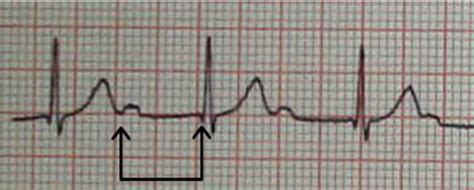 Electrocardiogram Demonstrating First Degree Heart Block In A Patient Download Scientific