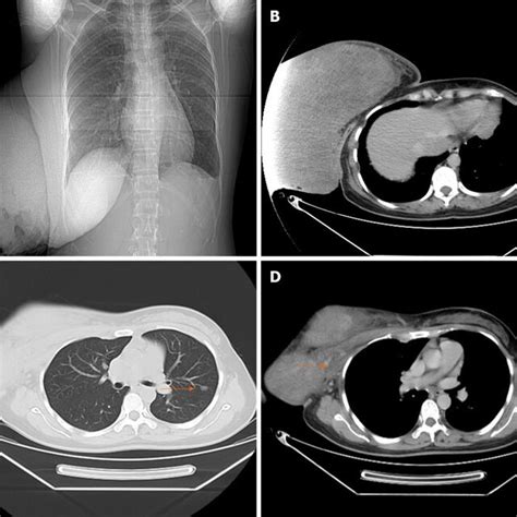 Preoperative Radiologic Evaluation A And B Chest Computed Tomography Download Scientific