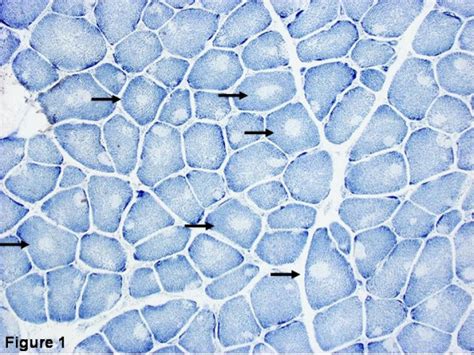 Histopathologic Appearance Of Typical Central Core Disease Nadh Tr