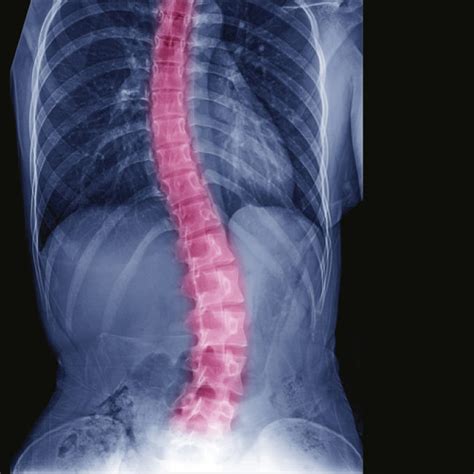 Scoliosis & Deformity Surgery – Ashish Patel, MD