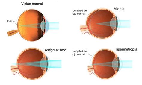Salud Visual Defectos Visuales Mas Comunes