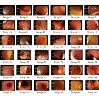 Tumor risk analysis result: the risk of benign tumor is 87.88% ...