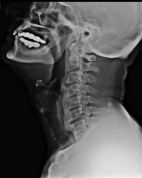 Diffuse Idiopathic Skeletal Hyperostosis Hyperostosis Frontalis