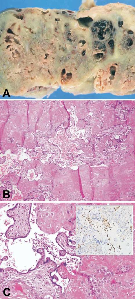 A Macroscopic Appearance Of Massive Perivillous Fibrin Deposition