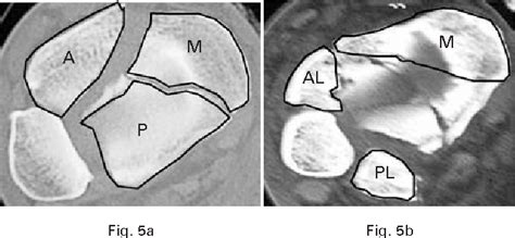 Figure 5 From Anatomy Of Pilon Fractures Of The Distal Tibia