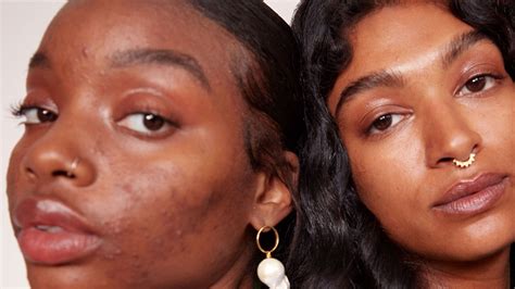 Pictures Of Blackheads On Black People