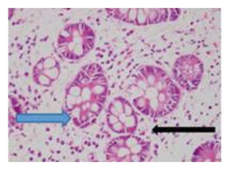 Histologic Findings Of Duodenal Biopsy The Duodenum Mucosa Shows A