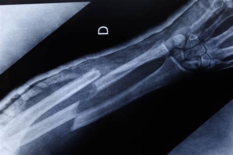 Broken Bones? Discover the Surprising Causes and Fast Treatment Options ...