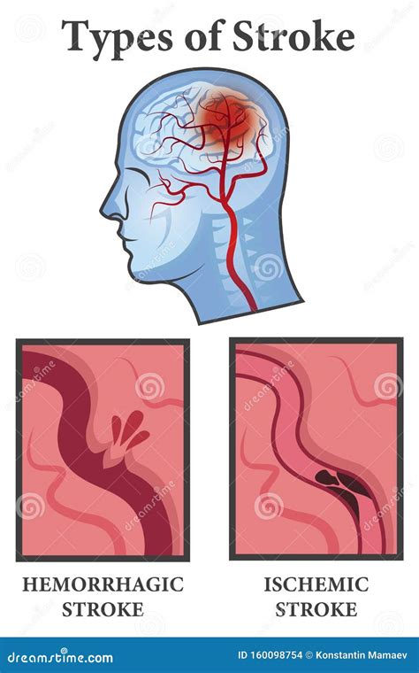 Hemorrhagic Stock Illustrationen Vektoren Kliparts 1 596 Stock