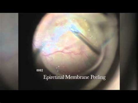 Epiretinal Membrane