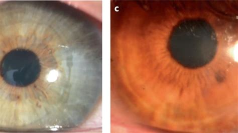 Troubles De La Vue Allodocteurs