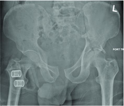 Initial Antero Posterior Ap Pelvic Radiograph Showing Pelvic Ring