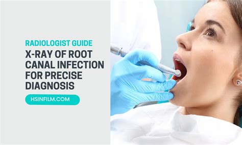 X-ray of Root Canal Infection for Precise Diagnosis - HSIN FILM