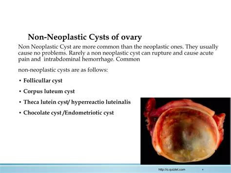 Pathology Ovarian Cyst And Tumors Dr Sufia Husain 2018 Ppt