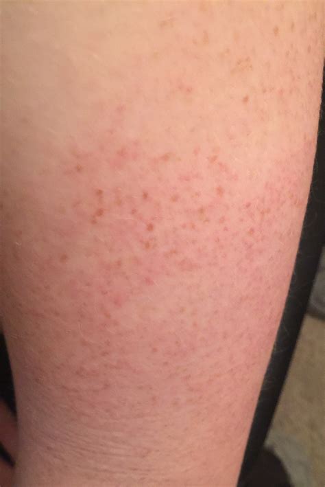 Rash On Thigh