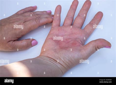 Strong Allergic Eczema On Hands Red Cracked Skin With Blisters Stock