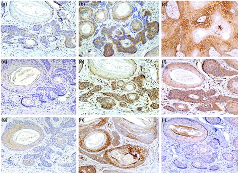 Immunohistochemical staining for hypoxia inducible factor 1α HIF1α