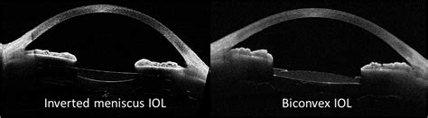 Visual Performance At All Distances And Patient Satisfaction With A New