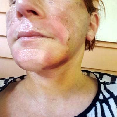 Lower Face And Neck Lift Recovery Photos (1) » Facelift: Info, Prices ...