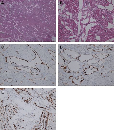 Laparoscopically Resected Uterine Adenomatoid Tumor With Coexisting